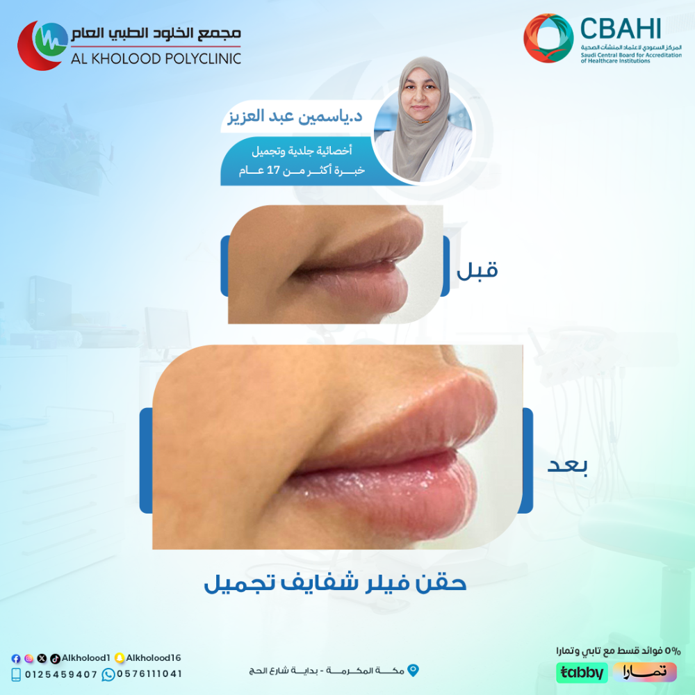 حقن فيلر شفايف مع الأخصائية   د. ياسمين عبد العزيز‍⚕️