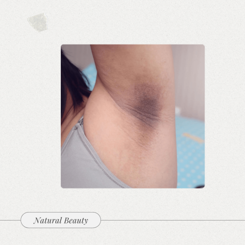 جلسة تصبغات الابطين | Underarm pigmentation sessio...