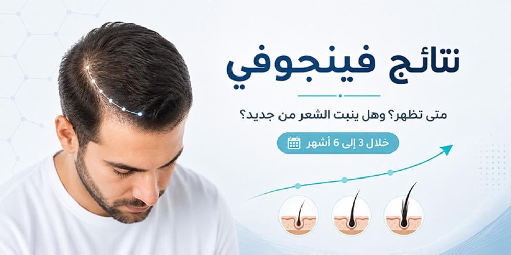 متى تظهر نتائج فينجوفي وهل ينبت الشعر من جديد