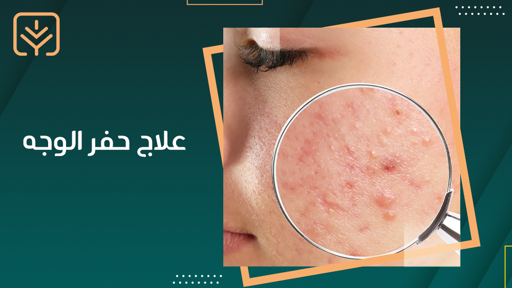 علاج حفر الوجه