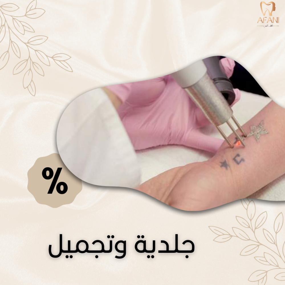 إزالة تاتو منطقة كبيرة