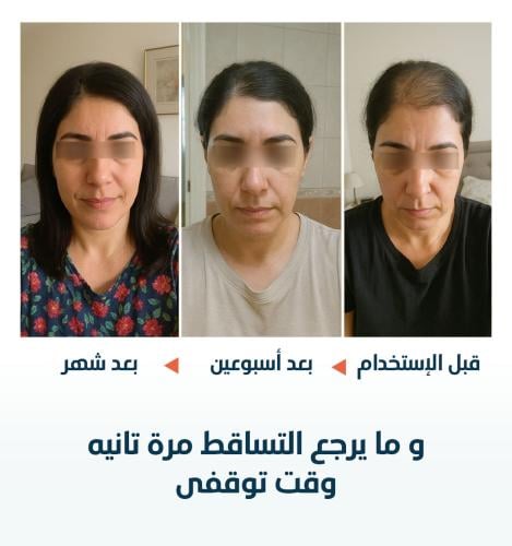 تساقط الشعر الناتج عن عوامل نفسيه و الحمل و الرضاعه
