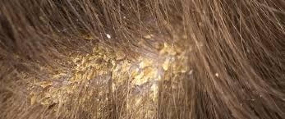 الإكزيما الدهنية للشعر: الأسباب والعلاج والممارسات الخاطئة المكونة لها