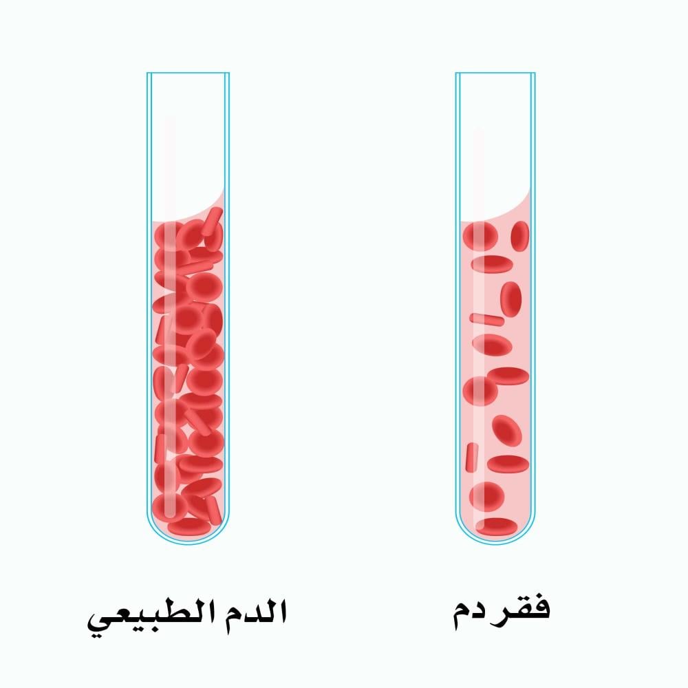 تحليل الحديد و فيريتين الدم : هل تعاني من فقر الدم دون أن تعلم؟