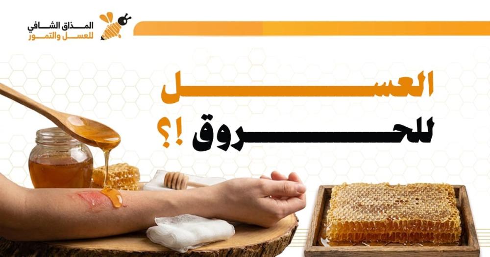 العسل للحروق
