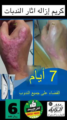 كريم ازاله اثر الندبات