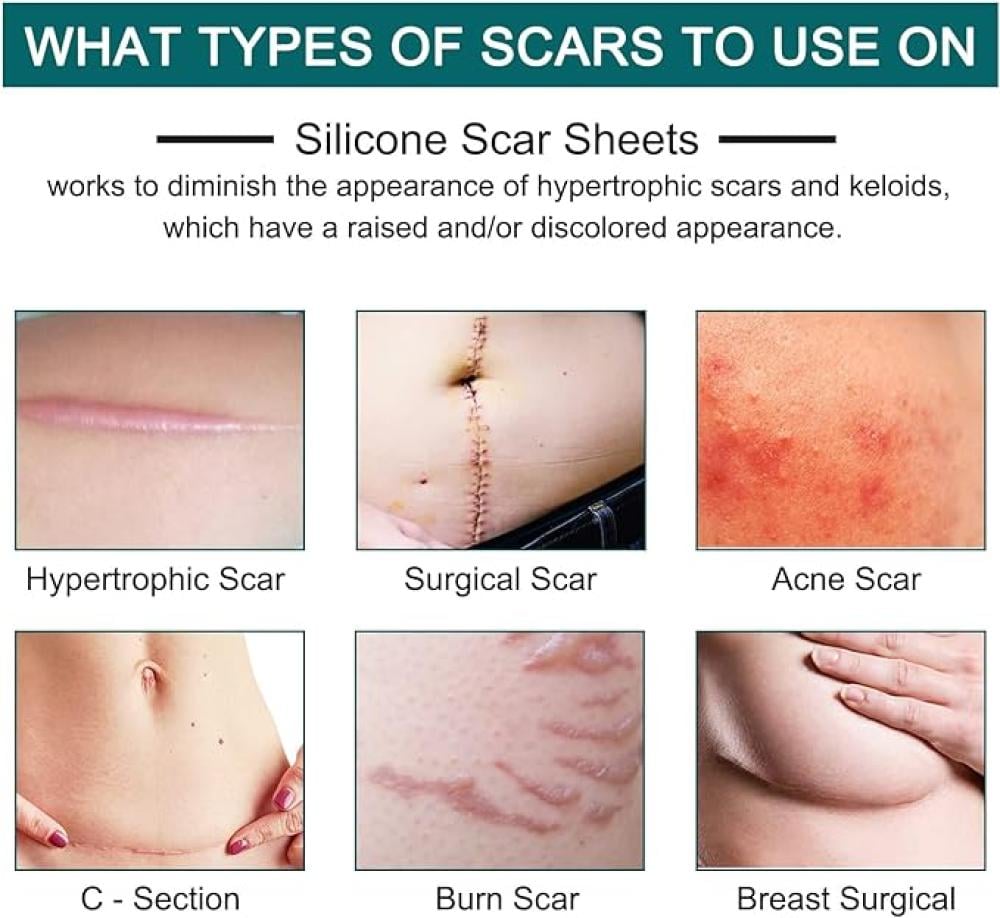 اشرطة الندبات سيليكون طبي بي كير 3 متر قابلة لإعادة الاستخدام
