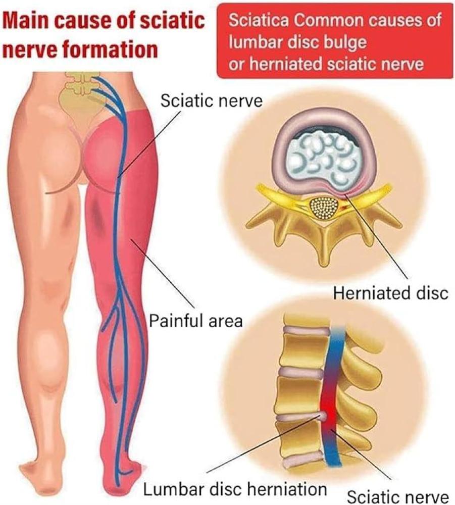 بخاخ موضعي لتخفيف الألم من جل بارد 5 قطع