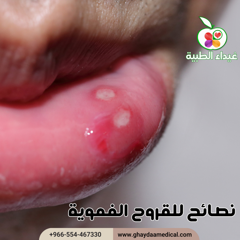 علاج التقرحات الفموية منزليًا وسبل الوقاية