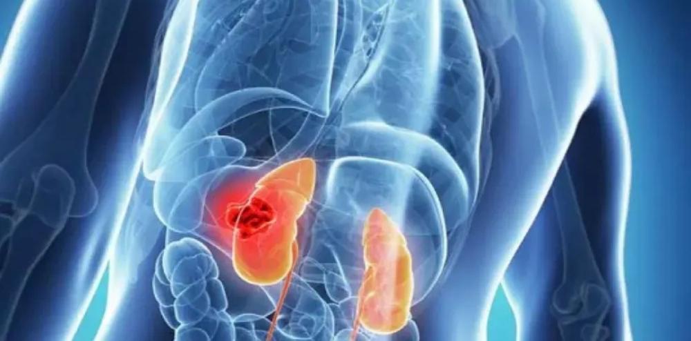 أمراض الكلى ماهي وطرق الوقايه منها