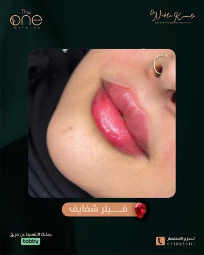 3 مل فيلر