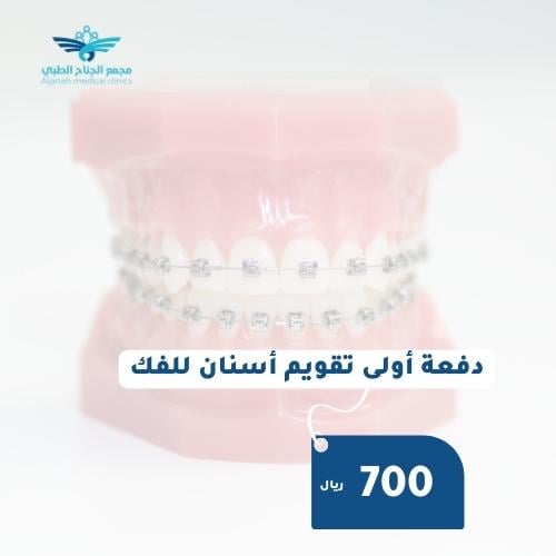 دفعة تقويم للفك