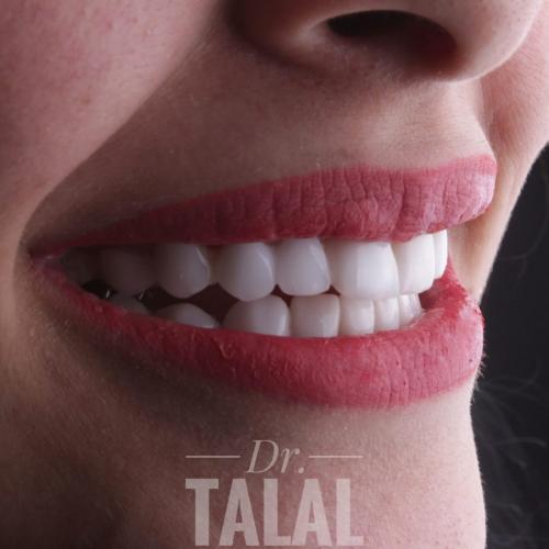 8 تركيبات اسنان زريكون