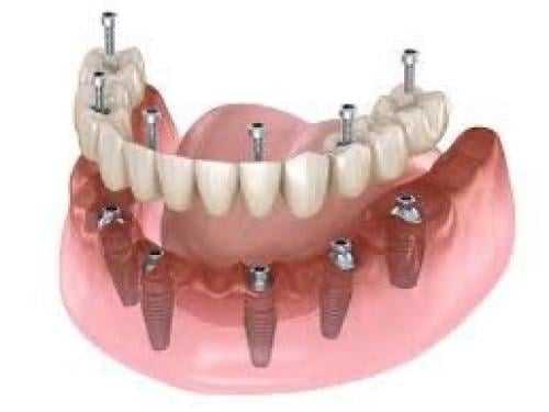 زراعة اسنان