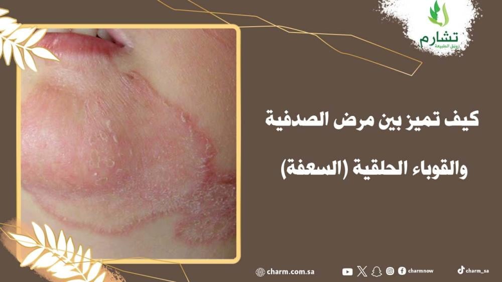 كيف تميز بين مرض الصدفية والقوباء الحلقية السعفة