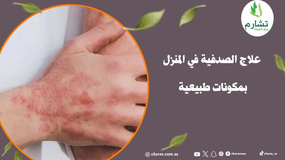 علاج الصدفية في المنزل بمكونات طبيعية