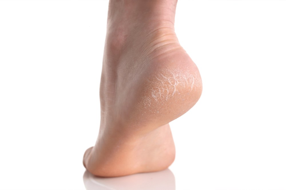 كيفية ازالة تشققات القدم بسهولة لمن يعانون من ظهورها على أقدامهم سواء
