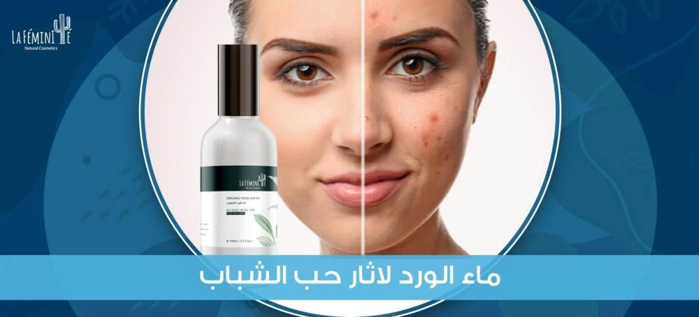 Benefits of rose water for acne scars