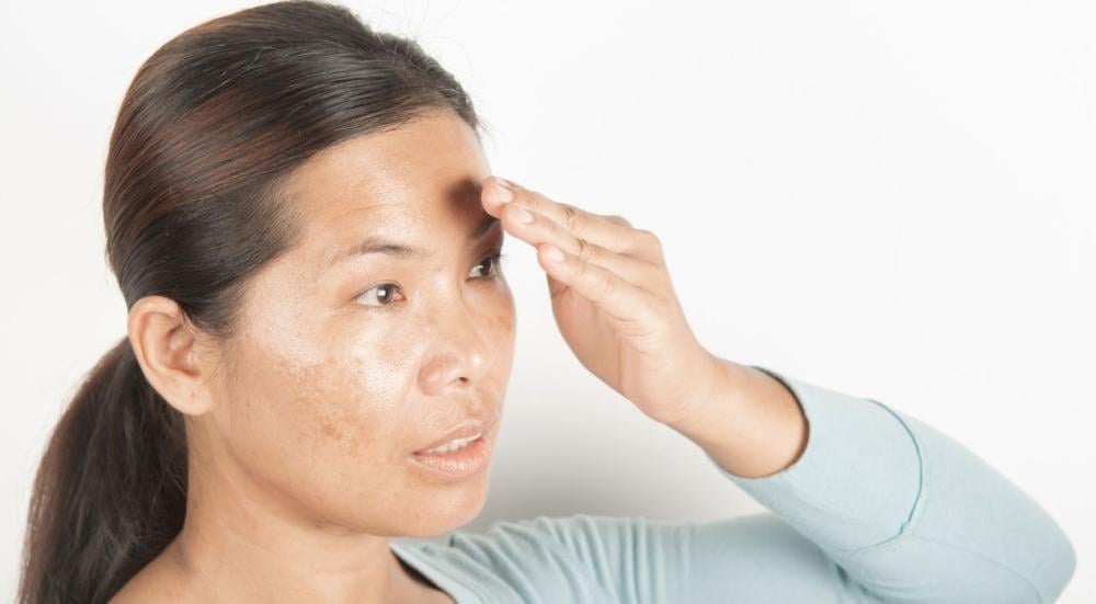 Dark spots on the face
