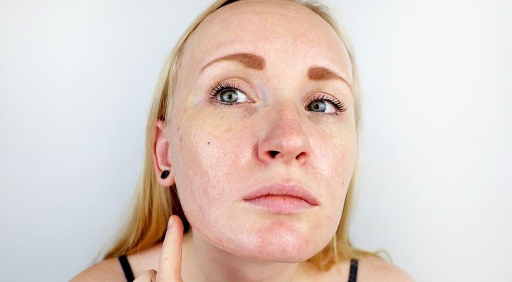 Oily skin problems