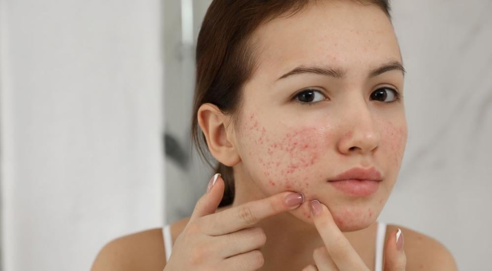 Getting rid of acne