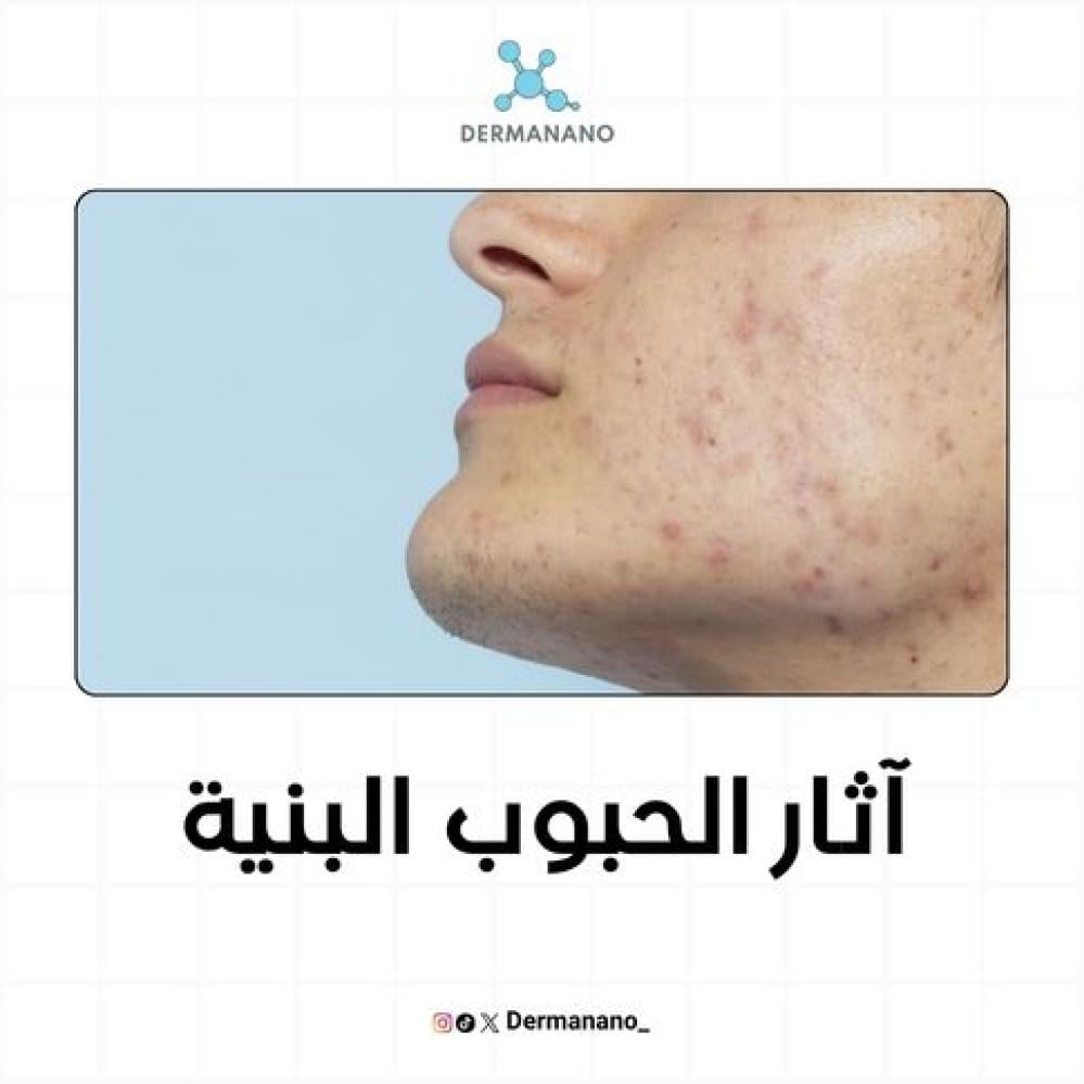 اثار الحبوب البنية وطرق التخلص منها والعناية بالبشرة