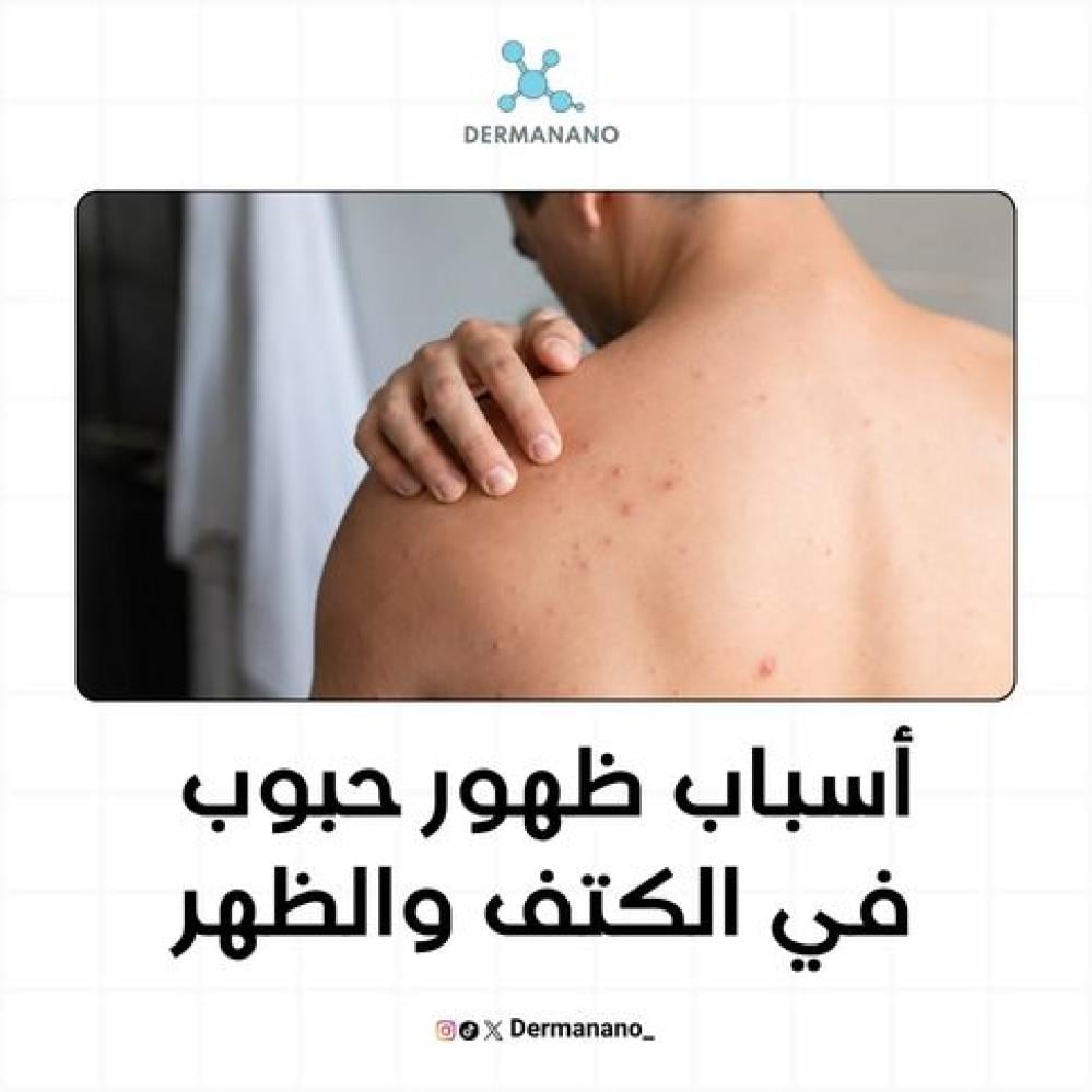 أسباب ظهور حبوب في الكتف والظهر