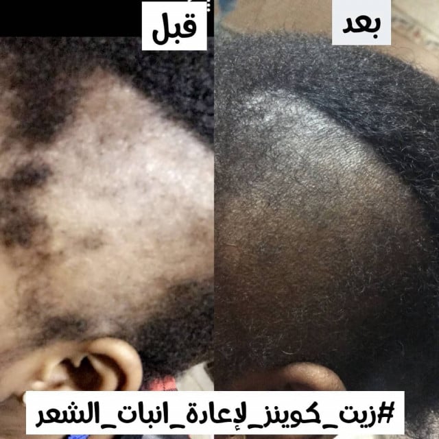 Queens Oil for Advanced Cases of Voids and Baldness Due to Hair Loss and  Traction Alopecia 60ml 2oz - كوينز كير