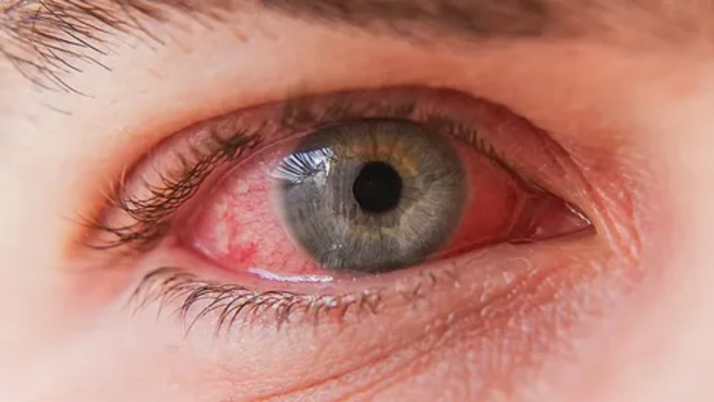 أسباب احمرار العين عند الأطفال
