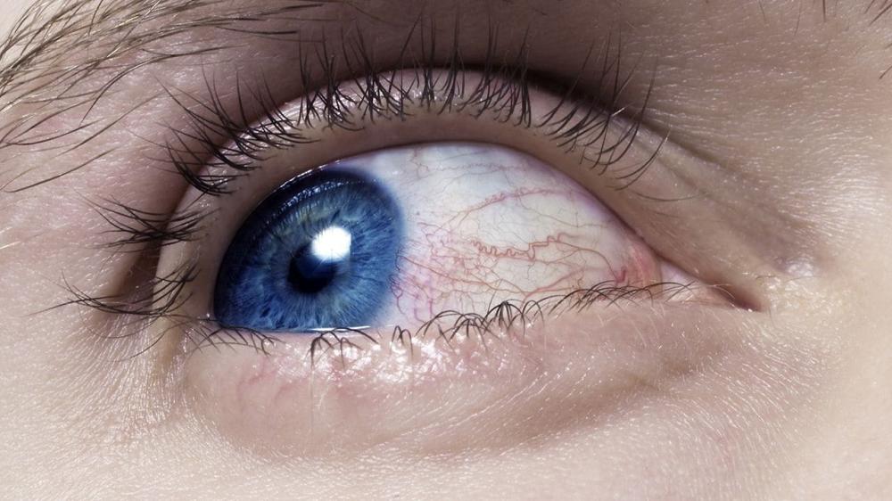 جرح-العيون - زكي للبصريات