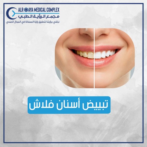 تبيض الأسنان فلاش بالعيادة