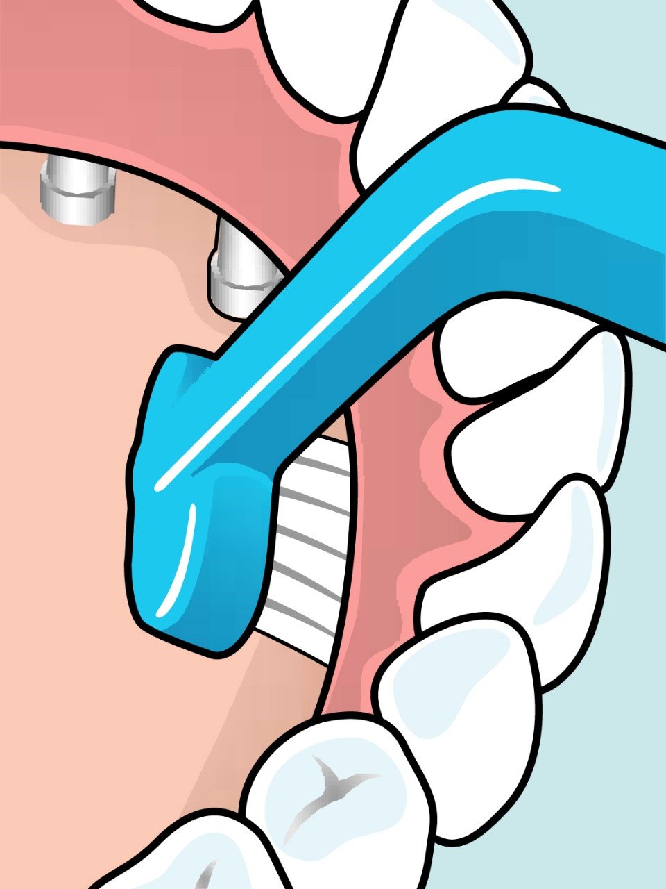 فرشاة أسنان خاصة بعد زراعة الأسنان UNIVERSAL CARE