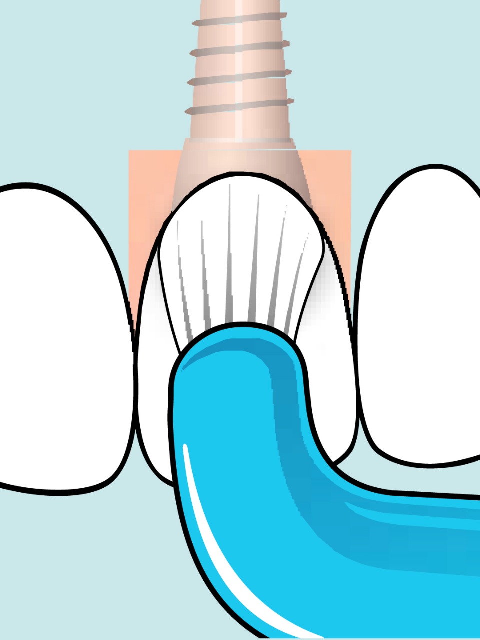 فرشاة أسنان خاصة بعد زراعة الأسنان UNIVERSAL CARE