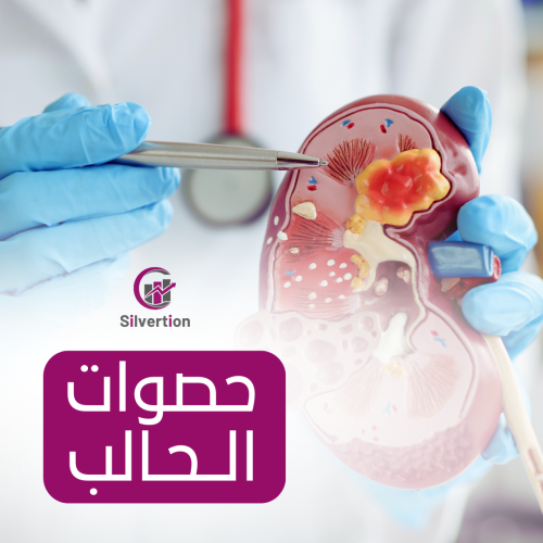 حصوات في الحالب