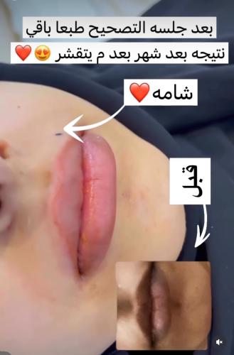 رتوش شفايف
