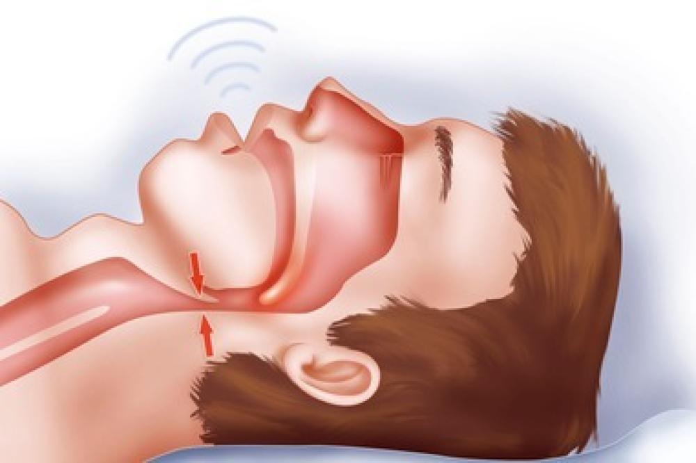 Obstructive Sleep Apnea: The Hidden Challenge to Sleep Health