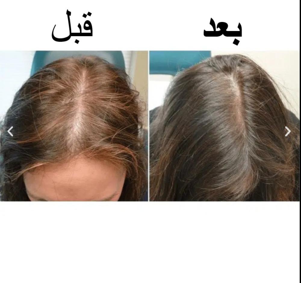 كورس معالجة الشعر المتضرر  – أفضل علاج لتساقط الشعر | Hair Restoration – The Best Hair Loss Treatment