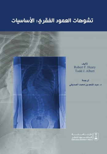 تشوهات العمود الفقري