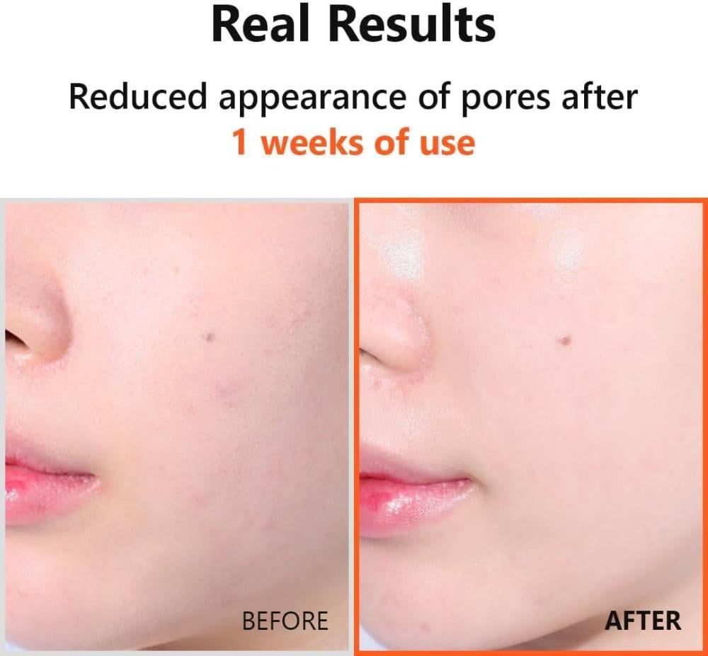 سيروم هايبر نياسيناميد من ازنتري