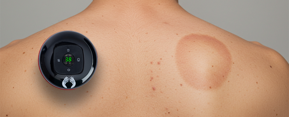 دليلك الشامل: الحجامة الجافة