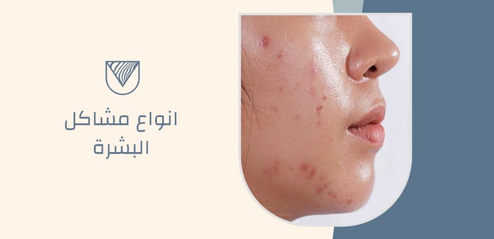 انواع مشاكل البشرة