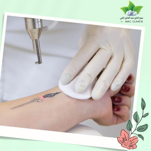 Permanent Laser Tattoo Removal Cost In Chennai