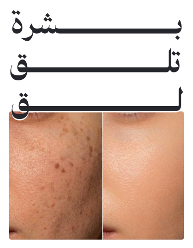 بشرة تلق لق