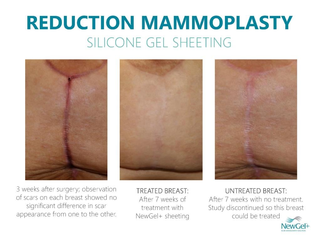 Neogel Silicone Areola Breast Patch (Clear - Pack of 2 Patches)