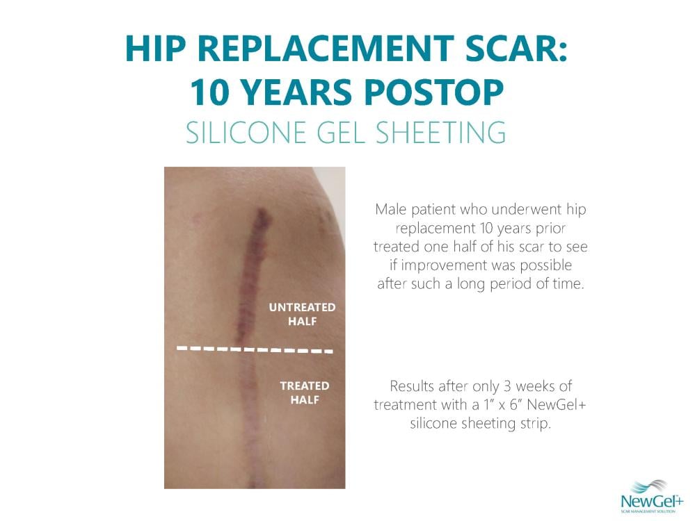 Neogel Silicone Areola Breast Patch (Clear - Pack of 2 Patches)