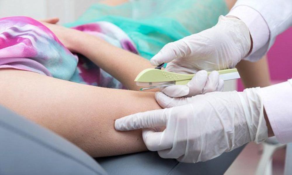 تركيب شريحة منع الحمل