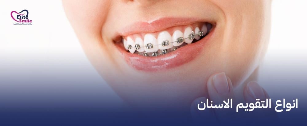 انواع التقويم الاسنان