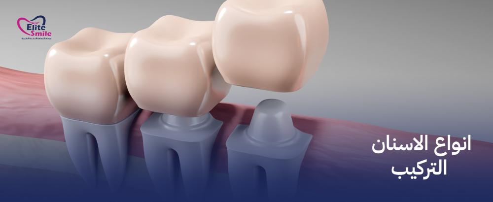 انواع الاسنان التركيب