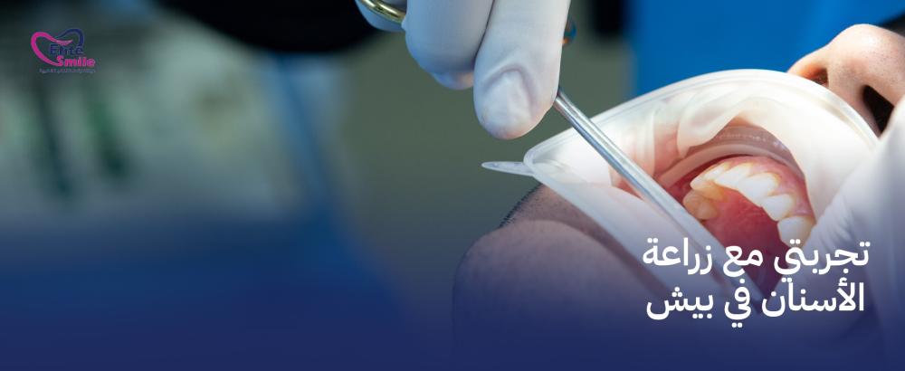 تجربتي مع زراعة الأسنان في بيش