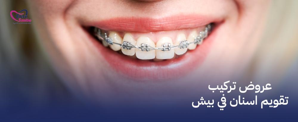 عروض تركيب تقويم اسنان في بيش